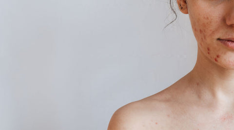 The Diet-Acne Connection