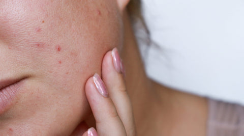 Adult Acne Is on the Rise - And No, It’s Not Just Hormones